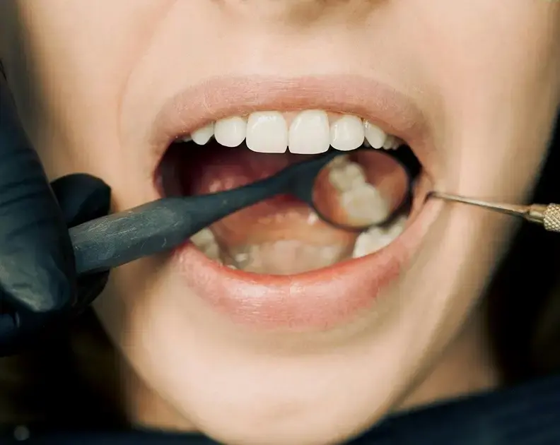 Entendendo os Tipos e Métodos de Clareamento Dental