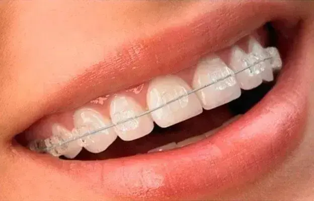 Benefícios do Uso de Aparelho Dental para o Seu Sorriso