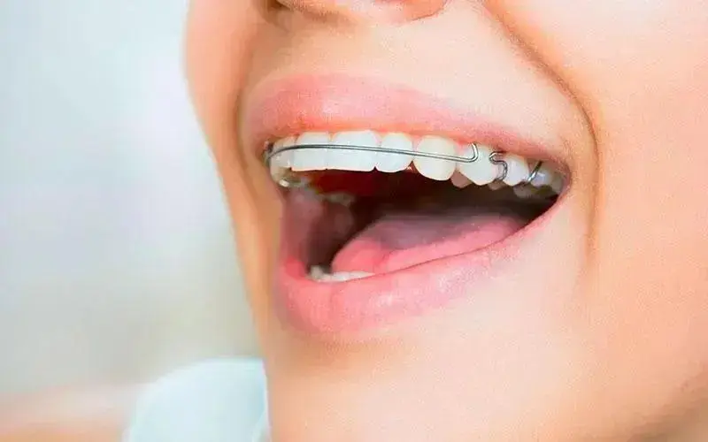 Como Escolher o Tipo Certo de Aparelho Dental