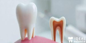 5 Fatos Importantes sobre o Dente Siso