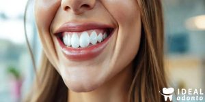 5 Vantagens da Lente de Contato Dental que Você Precisa Conhecer