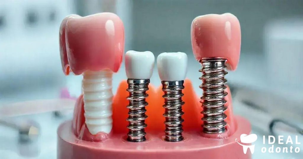 Implante Dentário: Porcelana ou Resina? Descubra o Melhor!