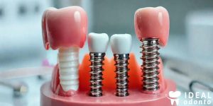 Implante Dentário: Porcelana ou Resina? Descubra o Melhor!